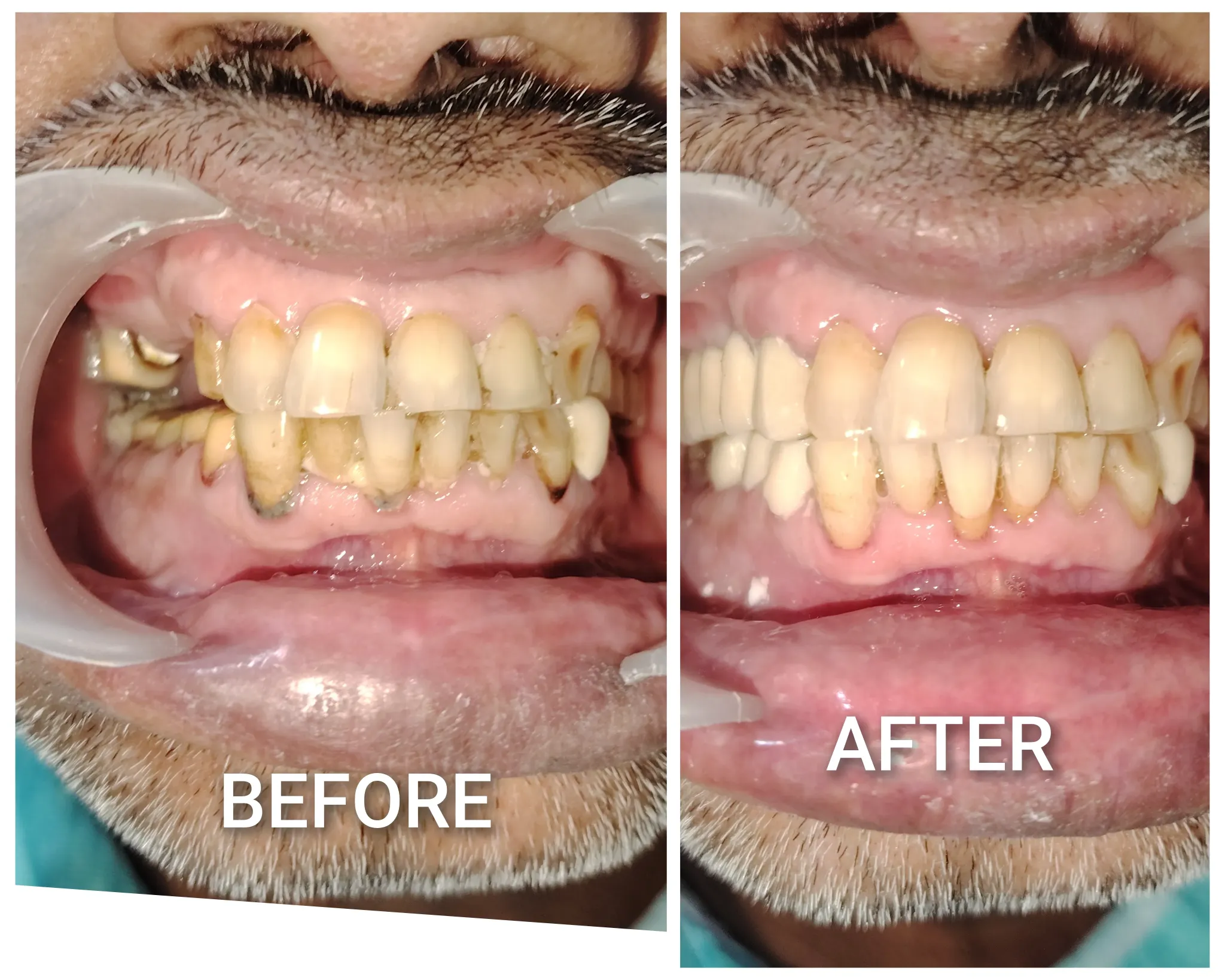 Before and after dental cleaning result