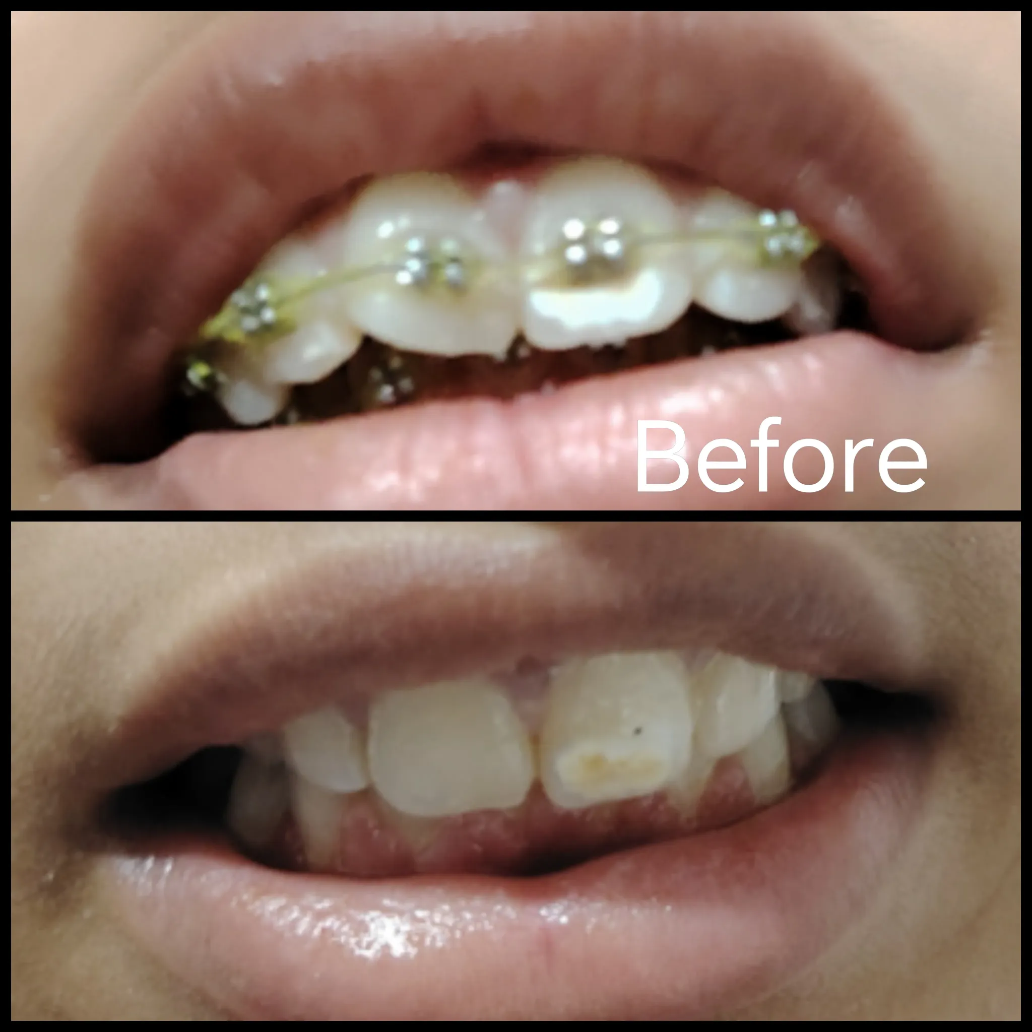 Orthodontic treatment result