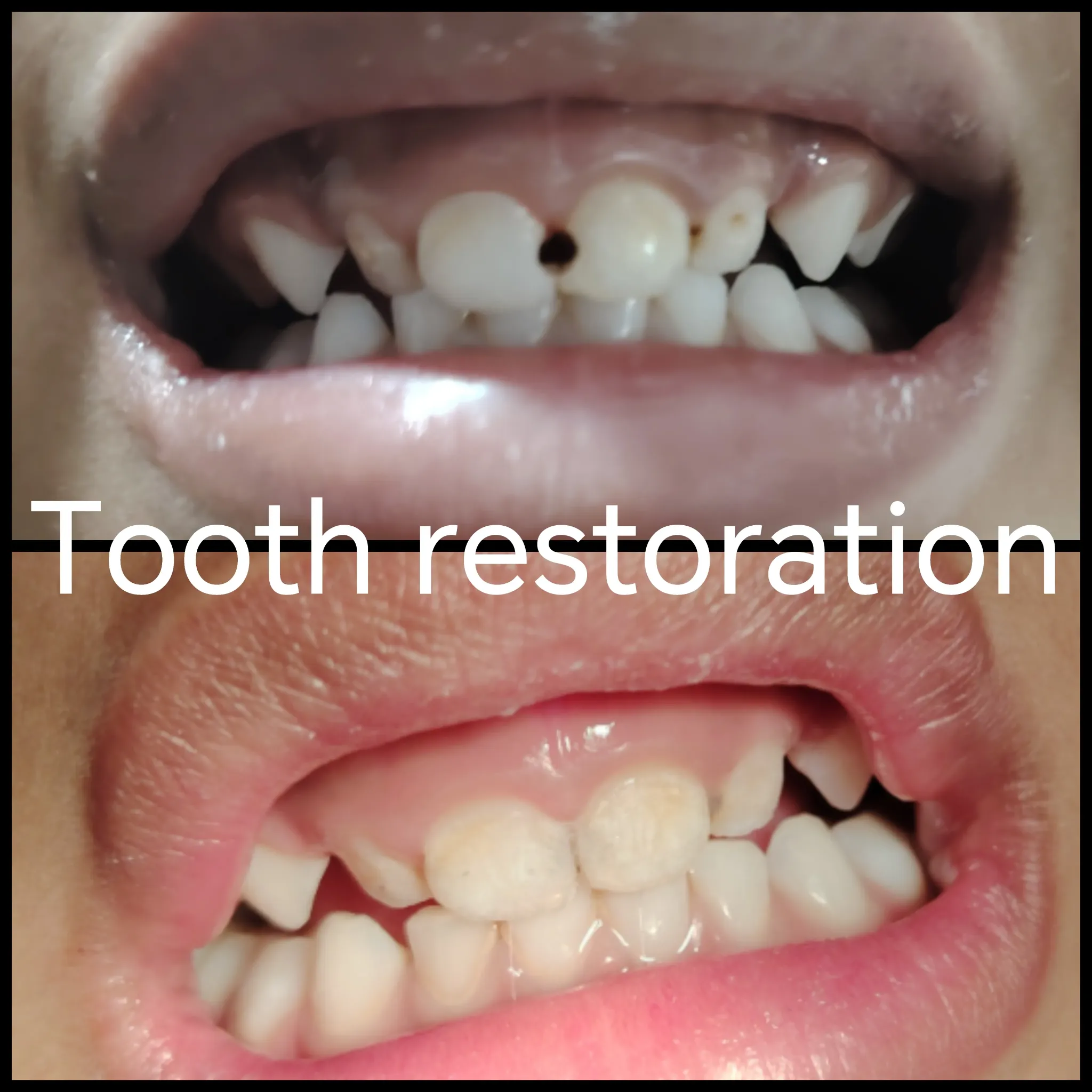 Tooth restoration before and after