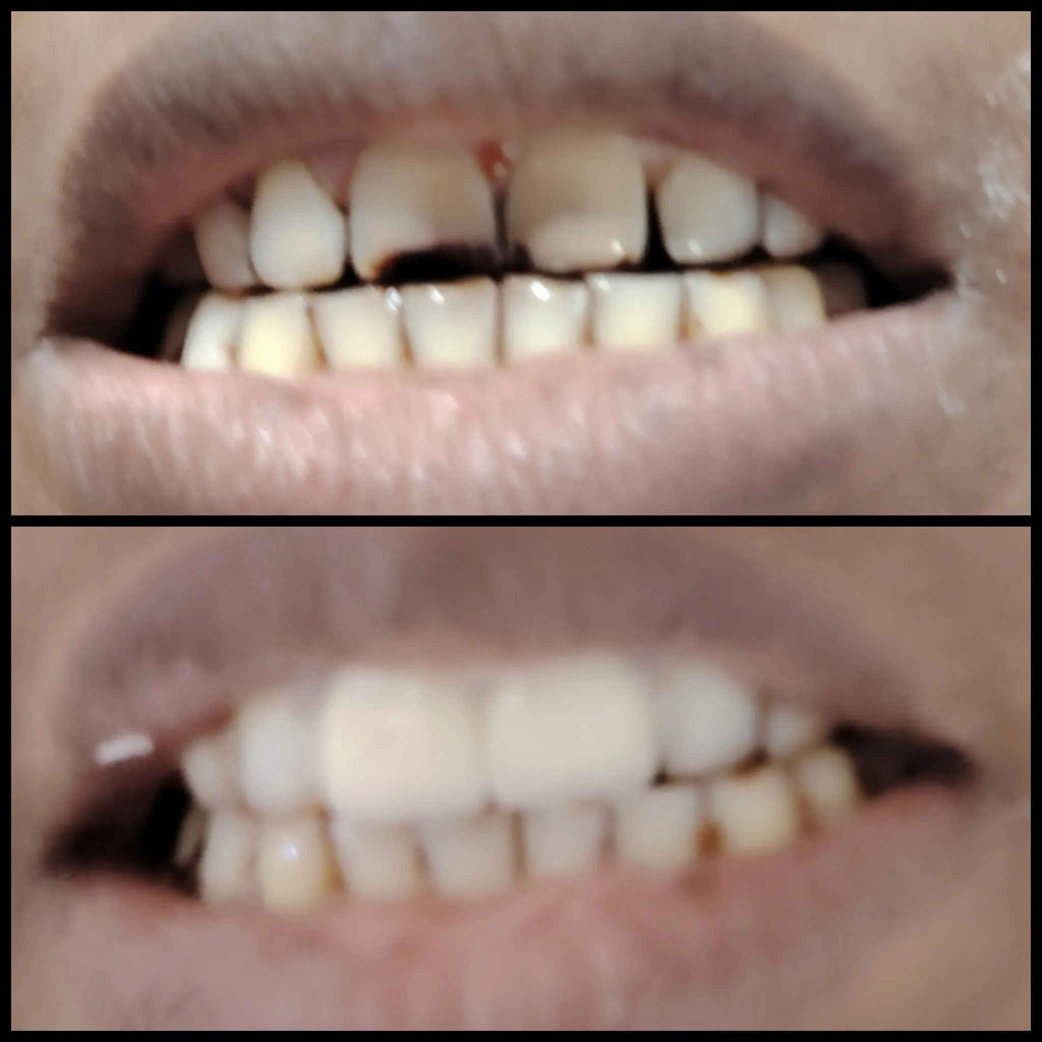 Dental restoration result
