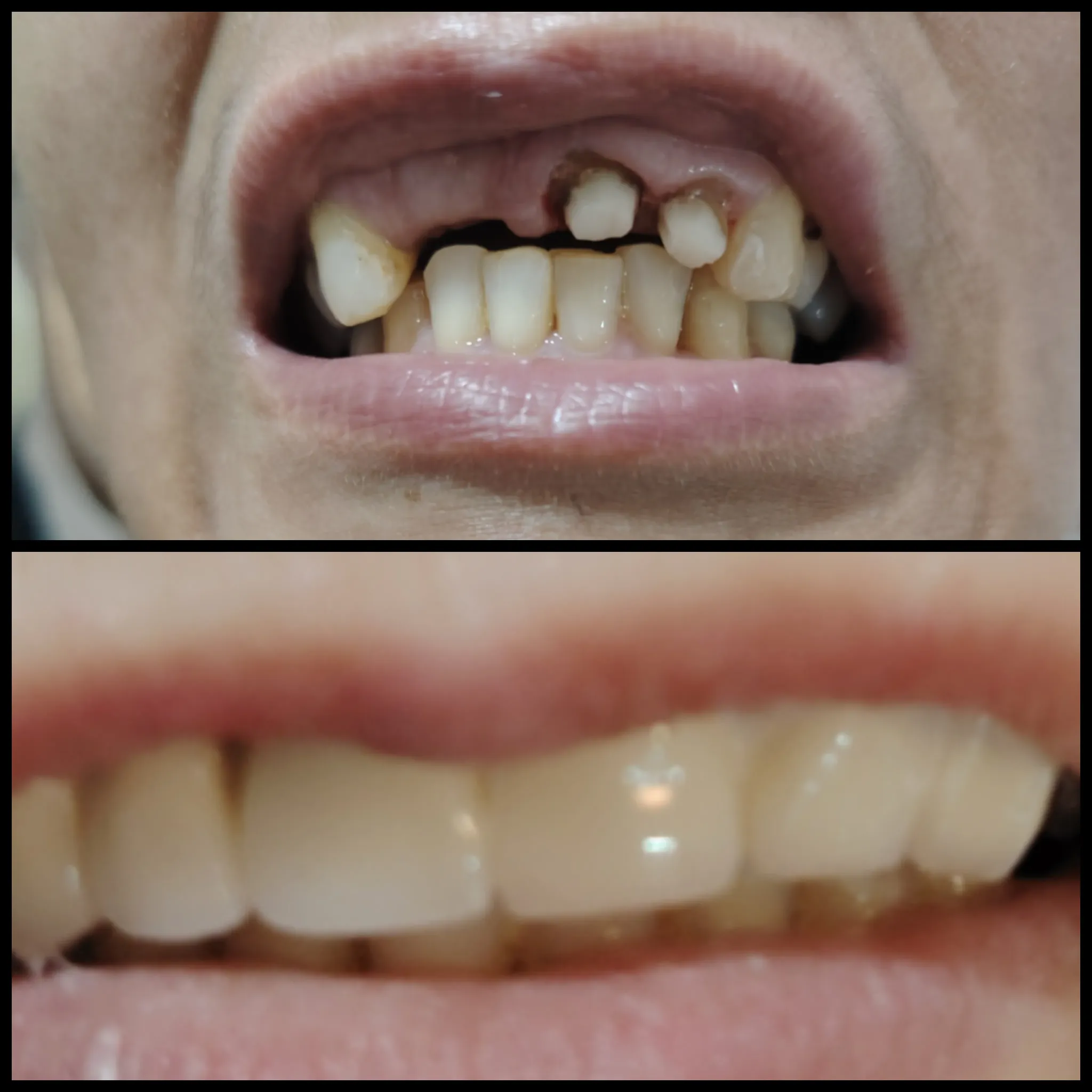 Dental restoration result