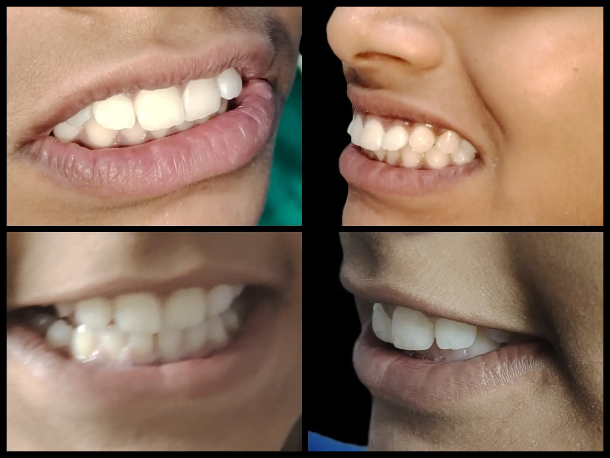 Smile treatment result collage